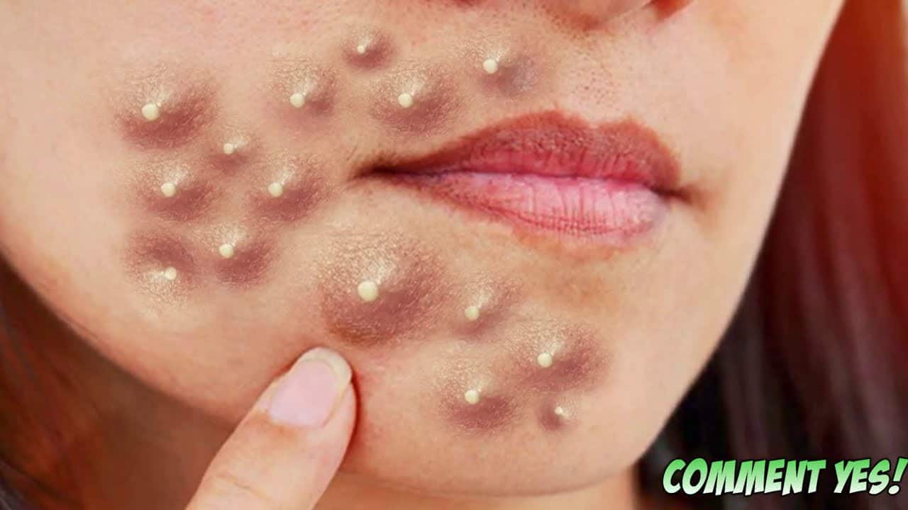 Watson's Top Pimple Pops!  Blackhead Pictures, Zits, Photoshops and Medical Educational Content