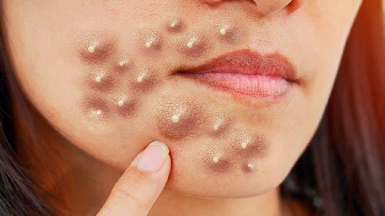 Watson's Top Pimple Pops with Photoshop Images