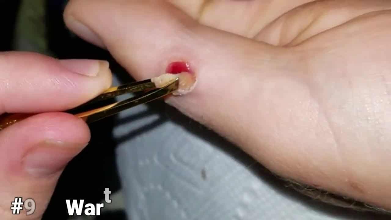 Weird Side of YouTube!  Best Pimple Pops and Extractions