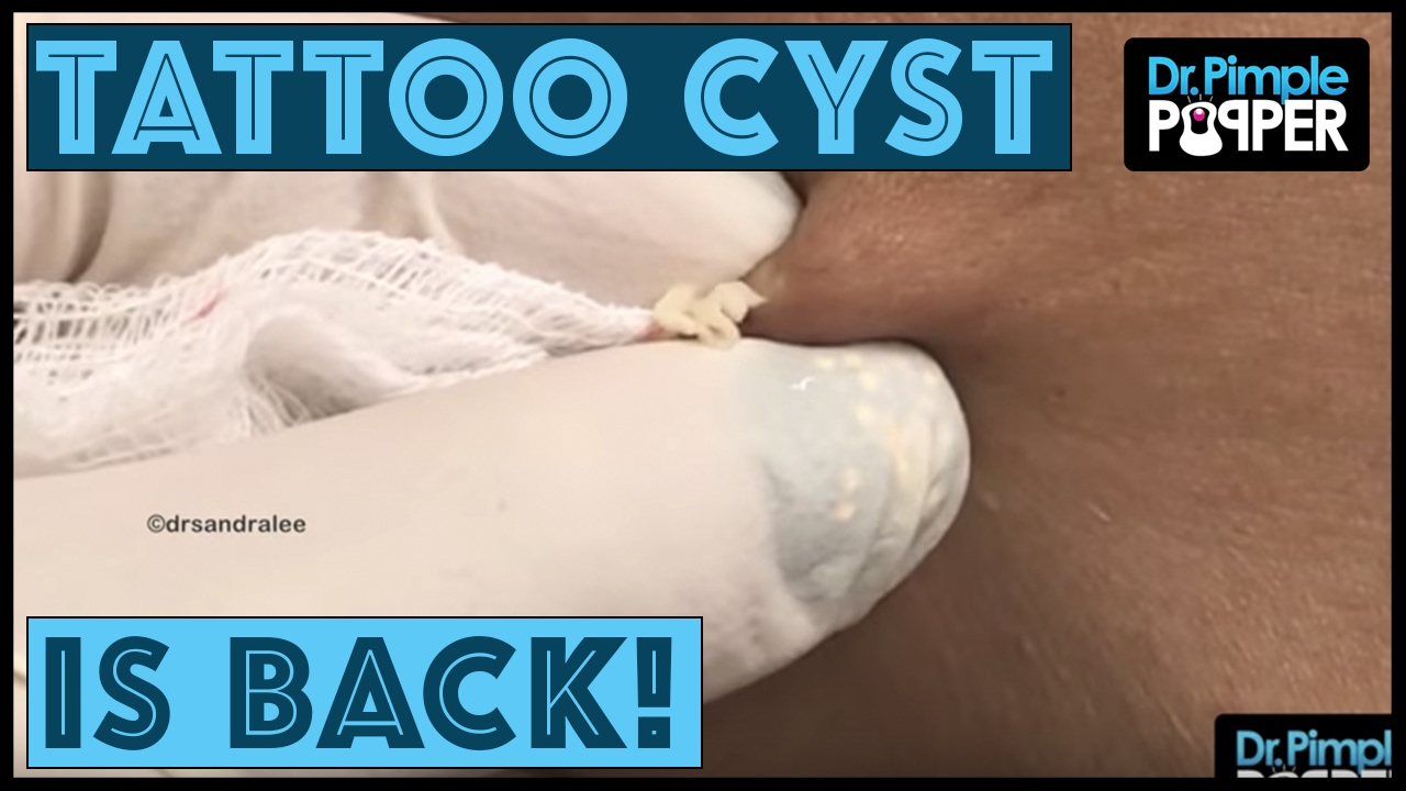 Welcome Back, Tattoo & Chit Chat! Dr Pimple Popper