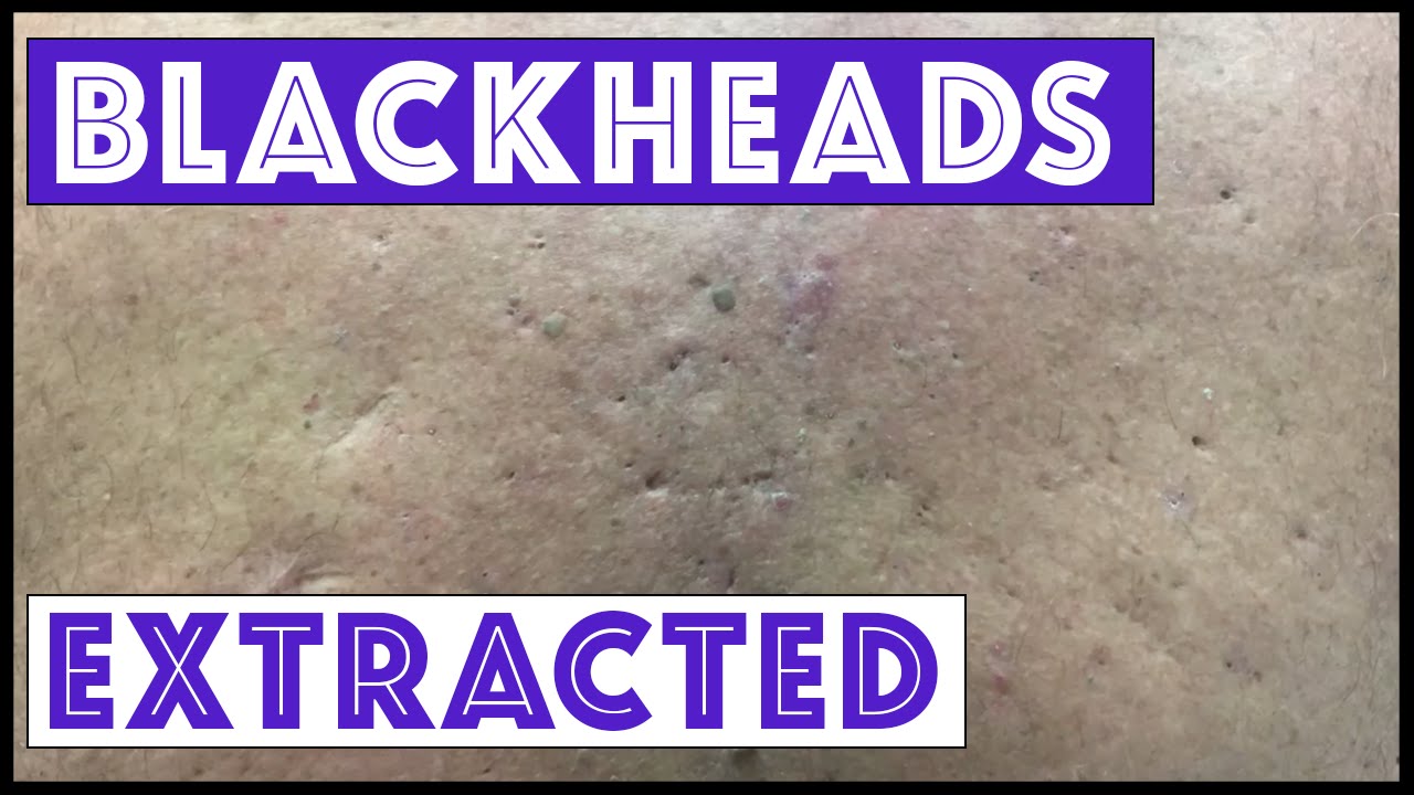 Were these blackheads & cysts from Agent Orange exposure?