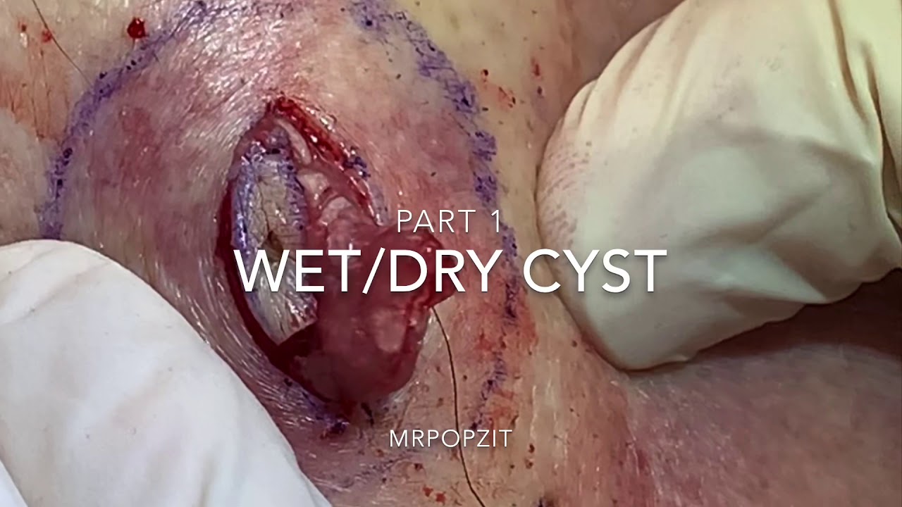 Wet/Dry Cyst Part 1