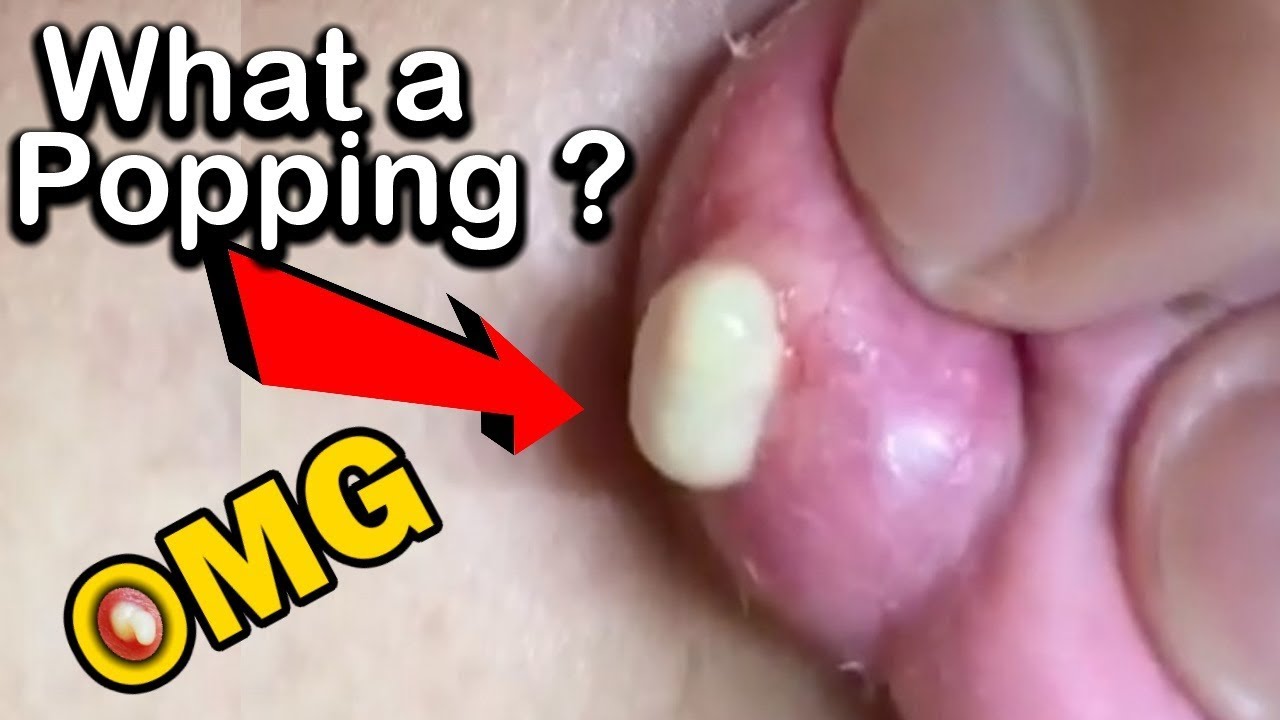 What an Amazing Blackhead removal/pimple popping..?Thank you for watching