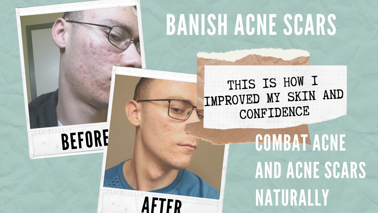 What are the best natural products for my acne and scars? / BANISH Acne Diaries: Joseph