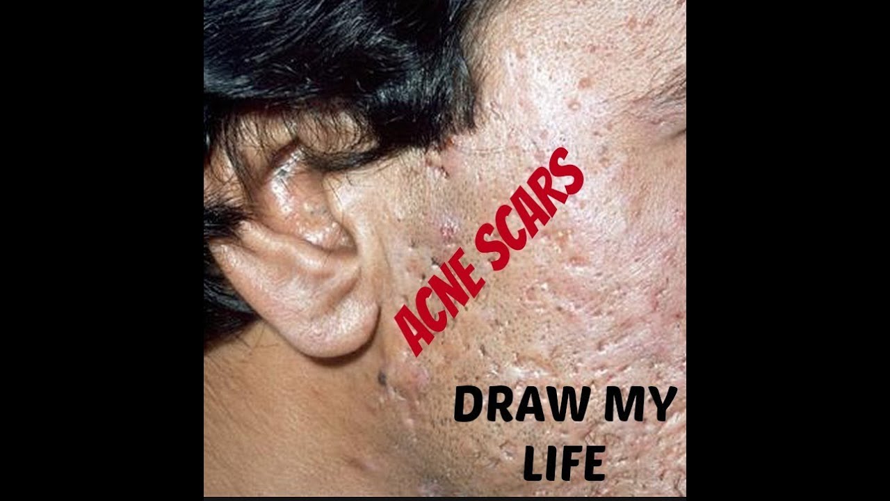 WHAT CAUSES ACNE AND ACNE SCARS? DRAW MY LIFE STYLE