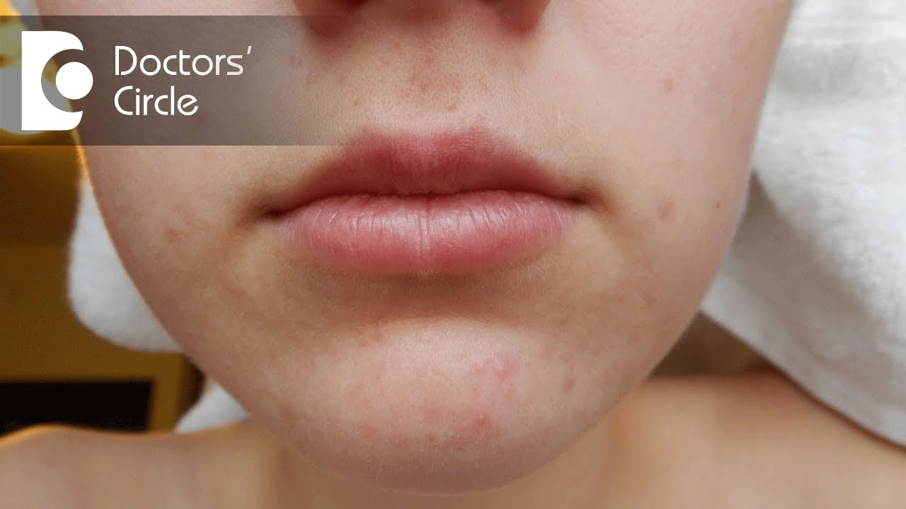 What causes acne around the mouth? – Dr. Aruna Prasad