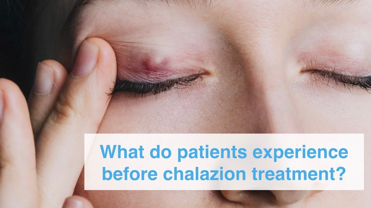 What do patients experience before chalazion treatment?