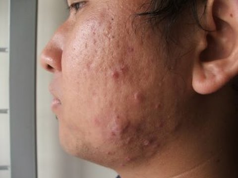 WHAT FOODS CAUSE ACNE???