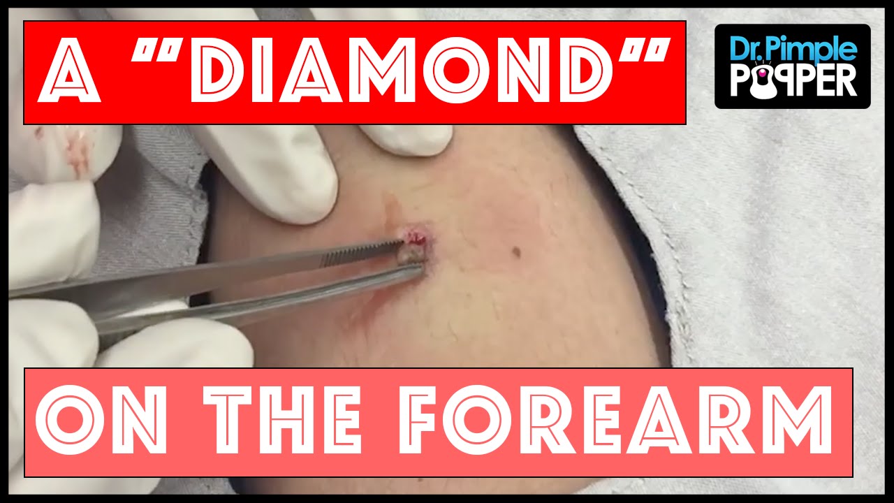 What if we grew Diamonds Under our Skin?!