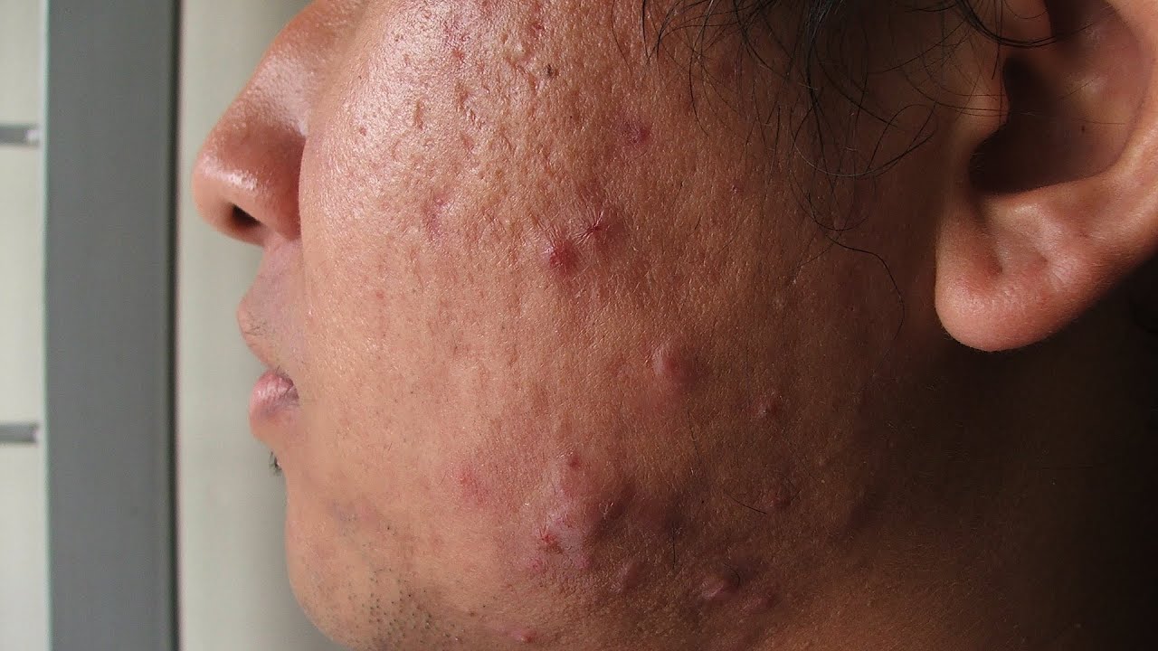 What Is Cystic Acne? | Acne Treatment
