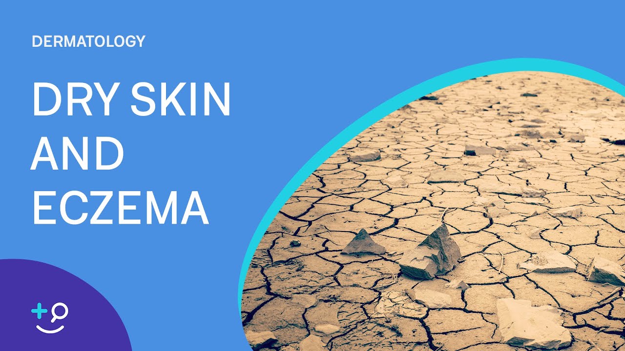 What is Eczema? – Eczema, Dry skin, and How to Treat