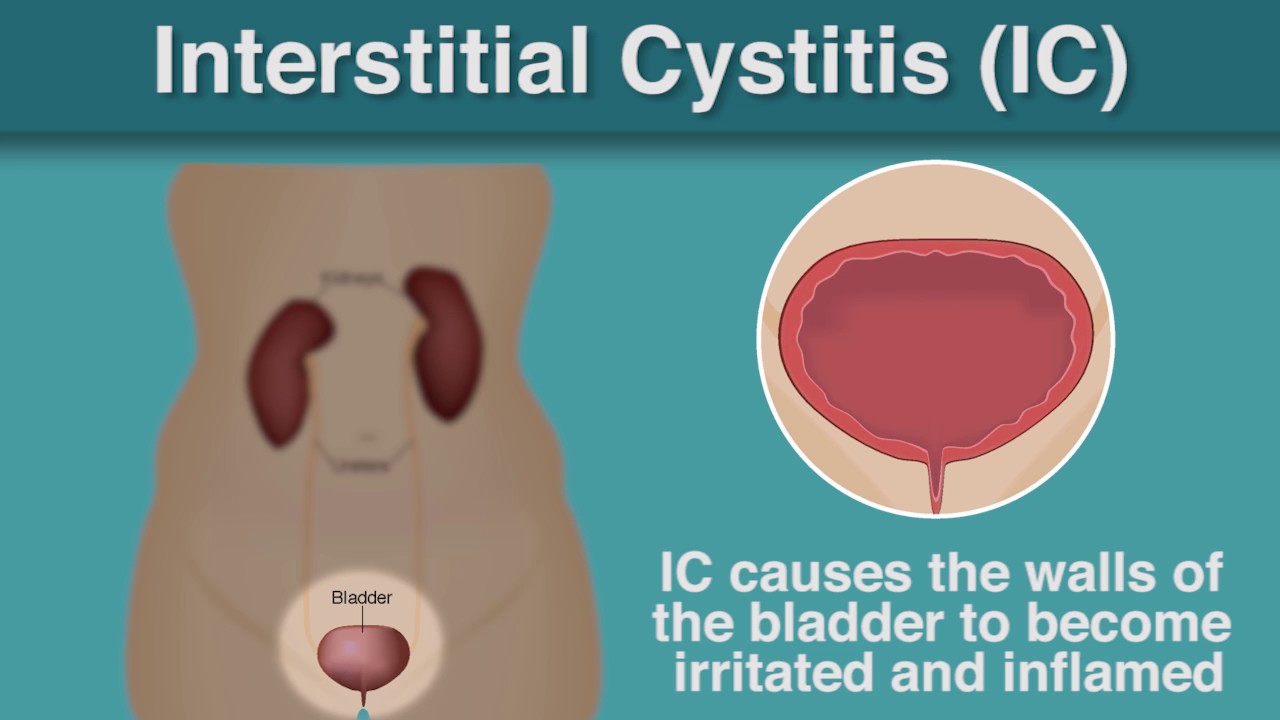 What Is – Interstitial Cystitis?