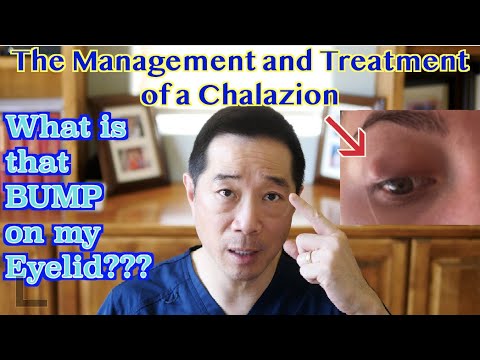 What is the bump on my eyelid?  Treatment of a Chalazion.