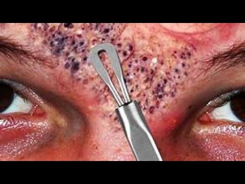 What is the SECRET to Pimple Popping!  Dermatology Videos!
