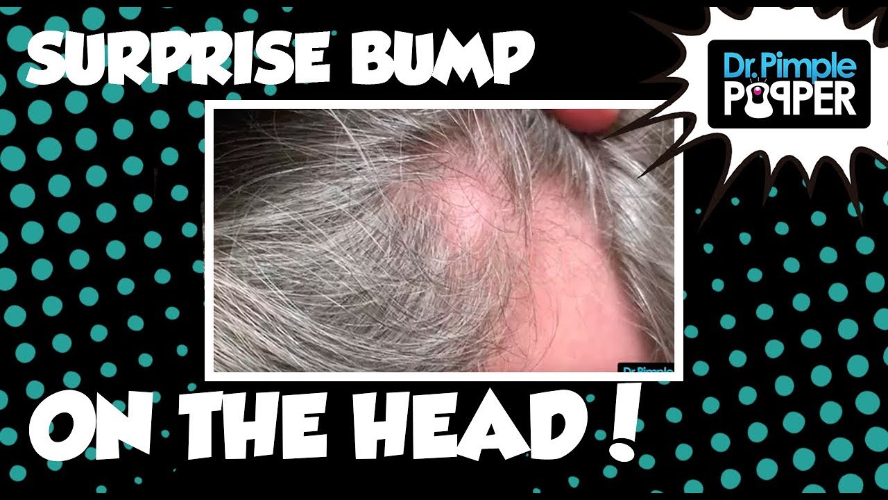 What is this on his Scalp? HINT: It’s not a Pilar Cyst