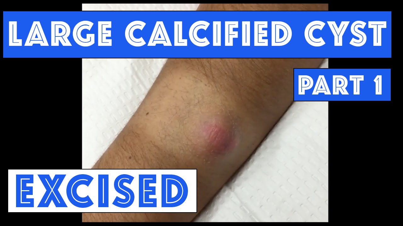 What kind of cyst is this?! Part 1 of 3