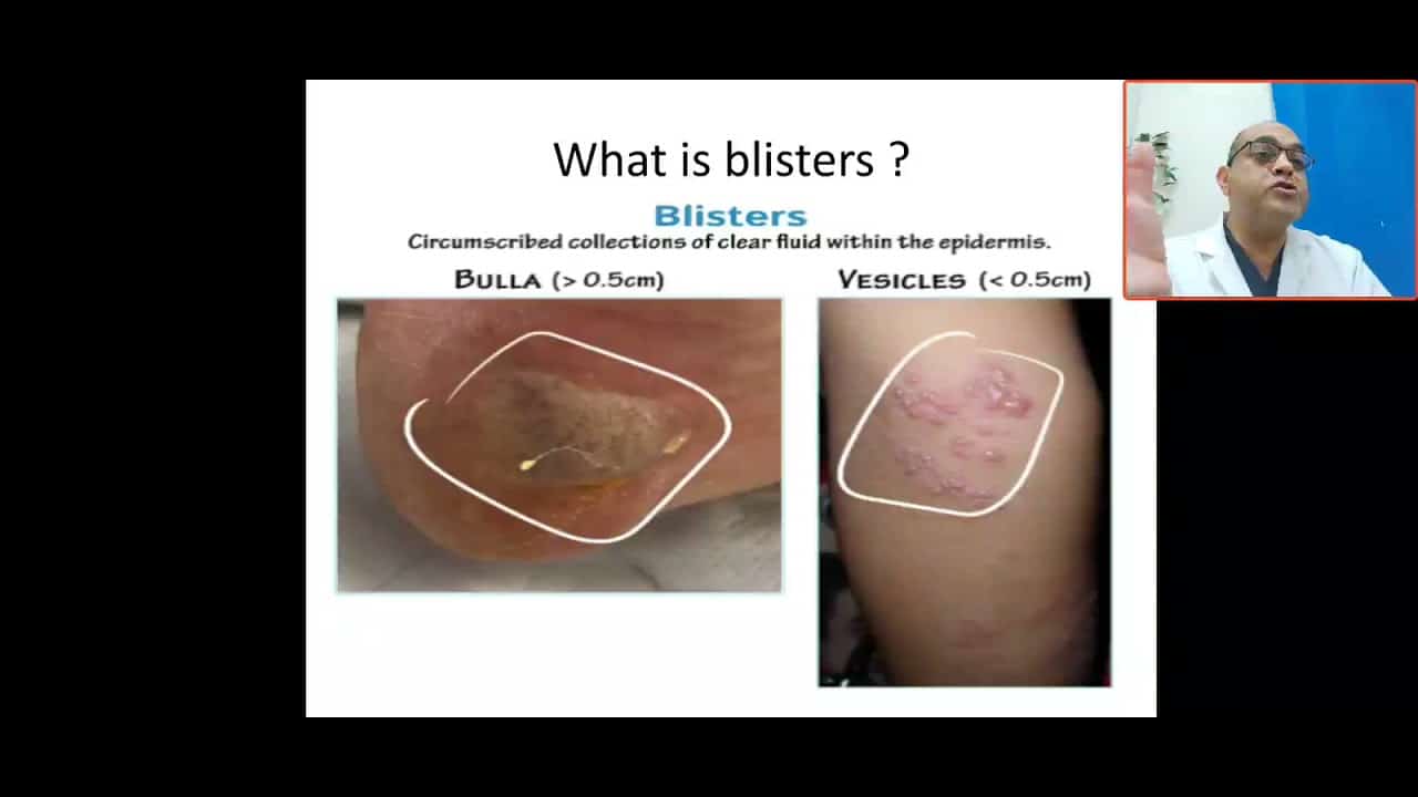 what's blisters? vesicles, bulla, HSV, bolus impetigo, varicella, pustule, fluid in the skin
