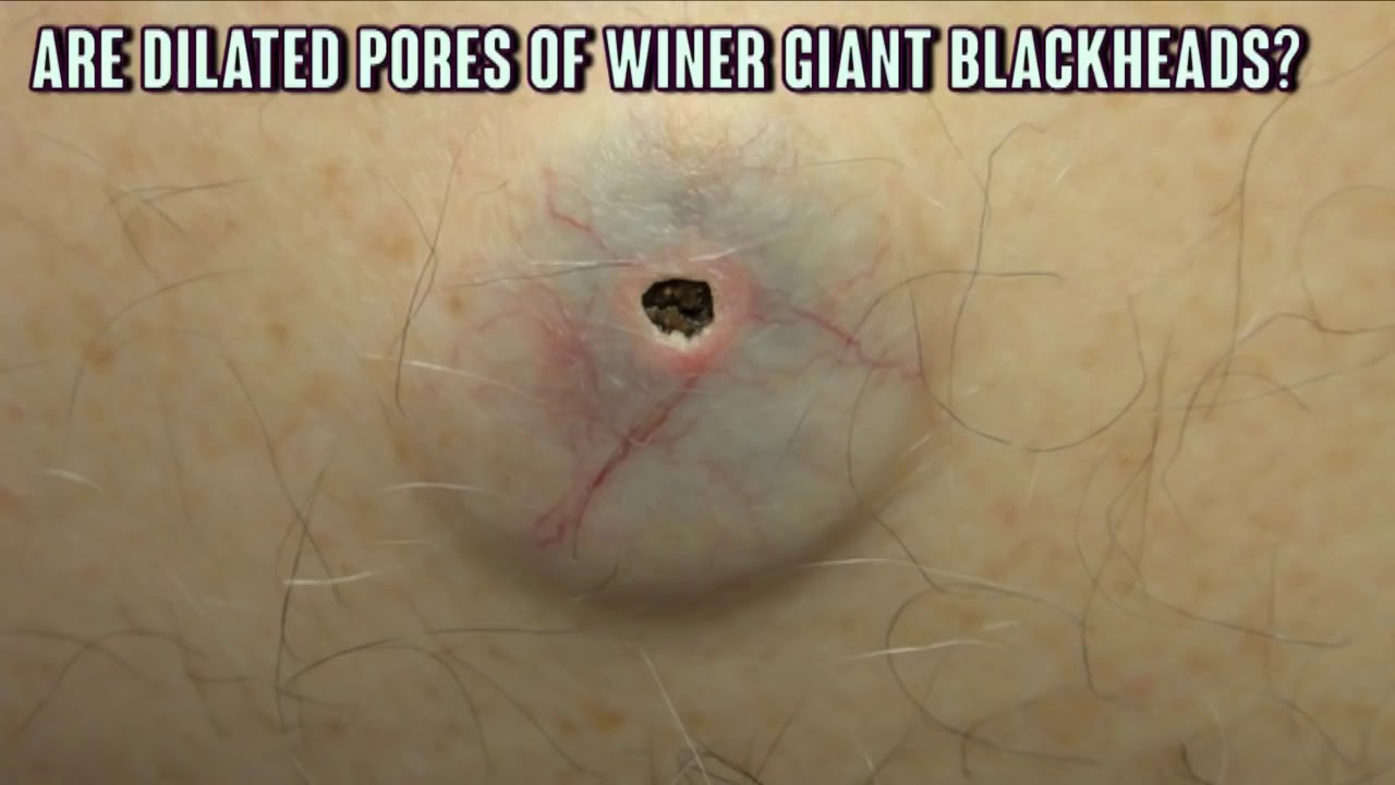 What's inside BLACKHEADS!  Pimple Popping Documentary