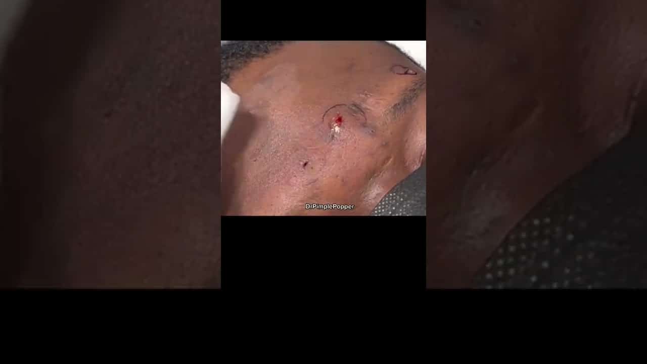 What’s your reaction? Steato Diamonds #drpimplepopper #shorts