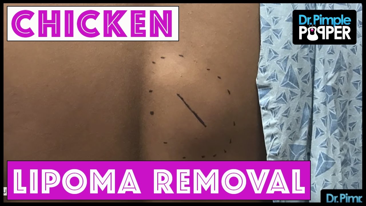 When a Lipoma Removal is as Good as Roscoe’s Chicken!