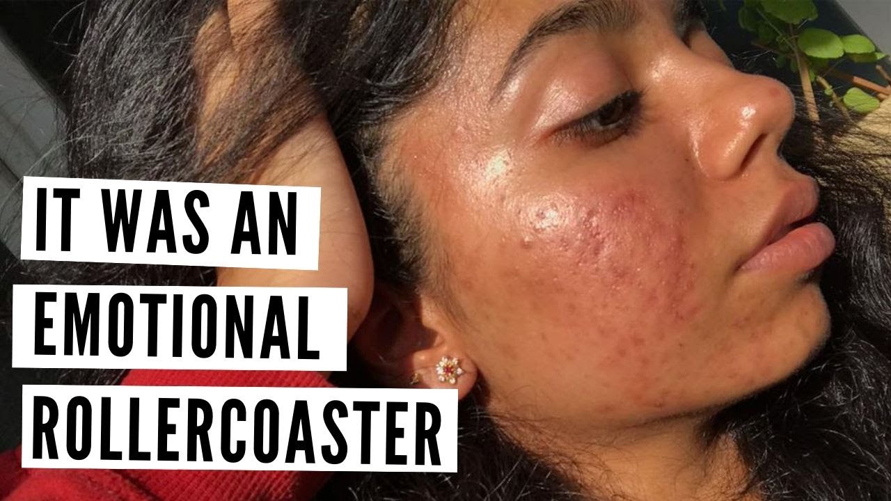 When Acne Makes You Cry… BANISH Acne Diaries: Megha´s Awareness Mission