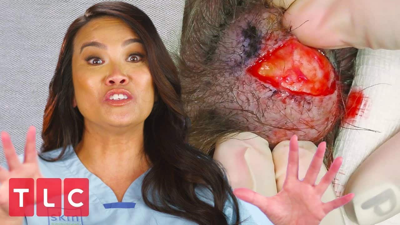 When Cysts Attack! | Dr. Pimple Popper (Compilation)