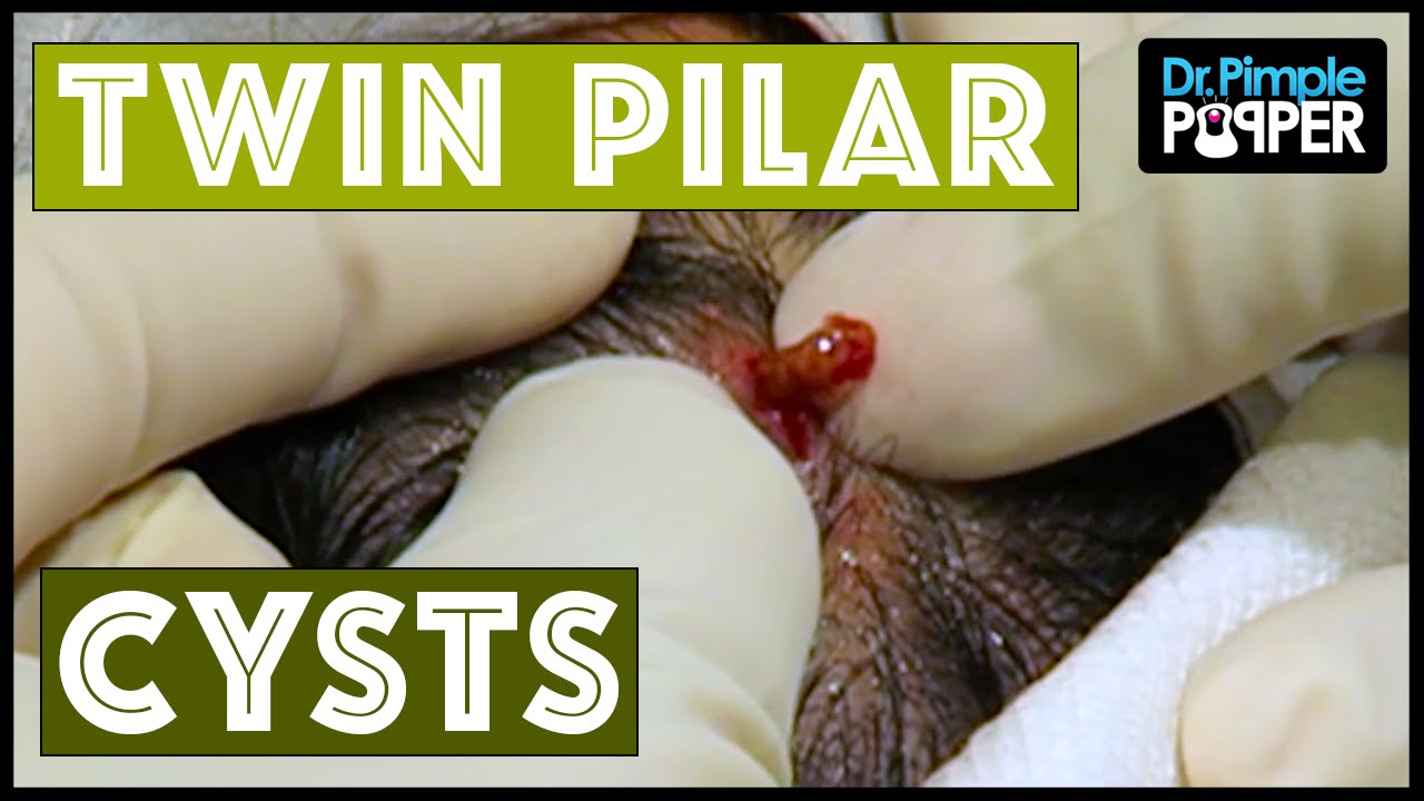 When you didn’t expect TWINS.  Pilar Cyst(s) & Dr Pimple Popper