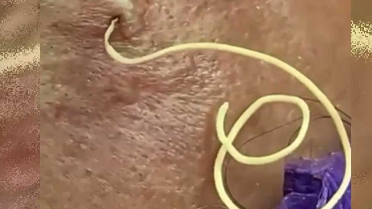 Where are the Biggest Cysts, Largest Blackheads, Pimple Pops and Whiteheads