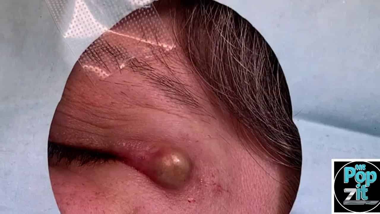 White mushroom eyelid cyst. Cyst pop and removal with closure right beside eye. Derm procedure.