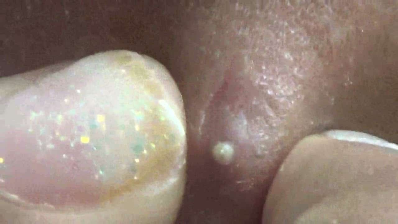 Whitehead Pimple Popping