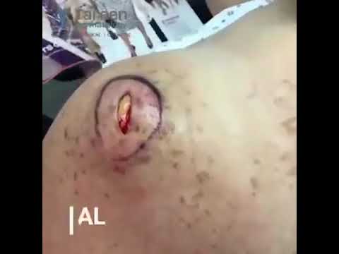 #Whiteheads #Acne New Pimple Popping Blackheads Removing