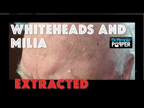 Whiteheads and milia extracted after Mohs surgery