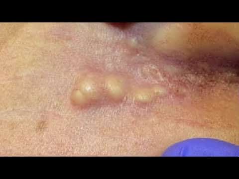 Whiteheads, Blackheads Extractions on the Ear
