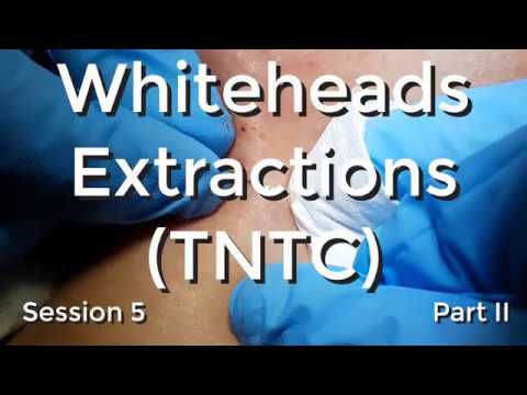 Whiteheads Extraction (TNTC) – Session 5 Part II