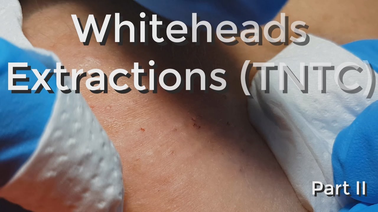 Whiteheads Extraction (TNTC) – Session I – Part 2 of 3