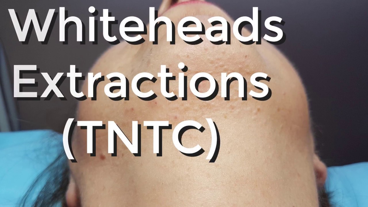 Whiteheads Extraction (TNTC) – Session I – Part 1