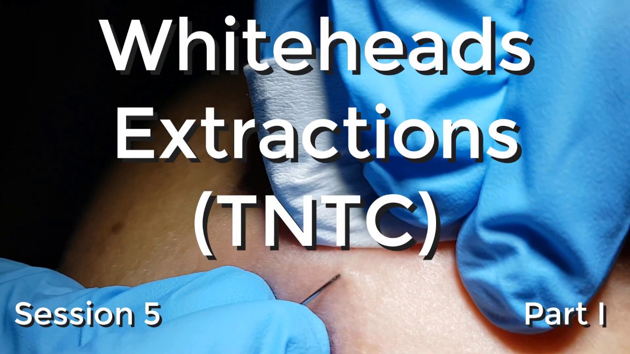 Whiteheads Extraction (TNTC) – Session 5 Part I