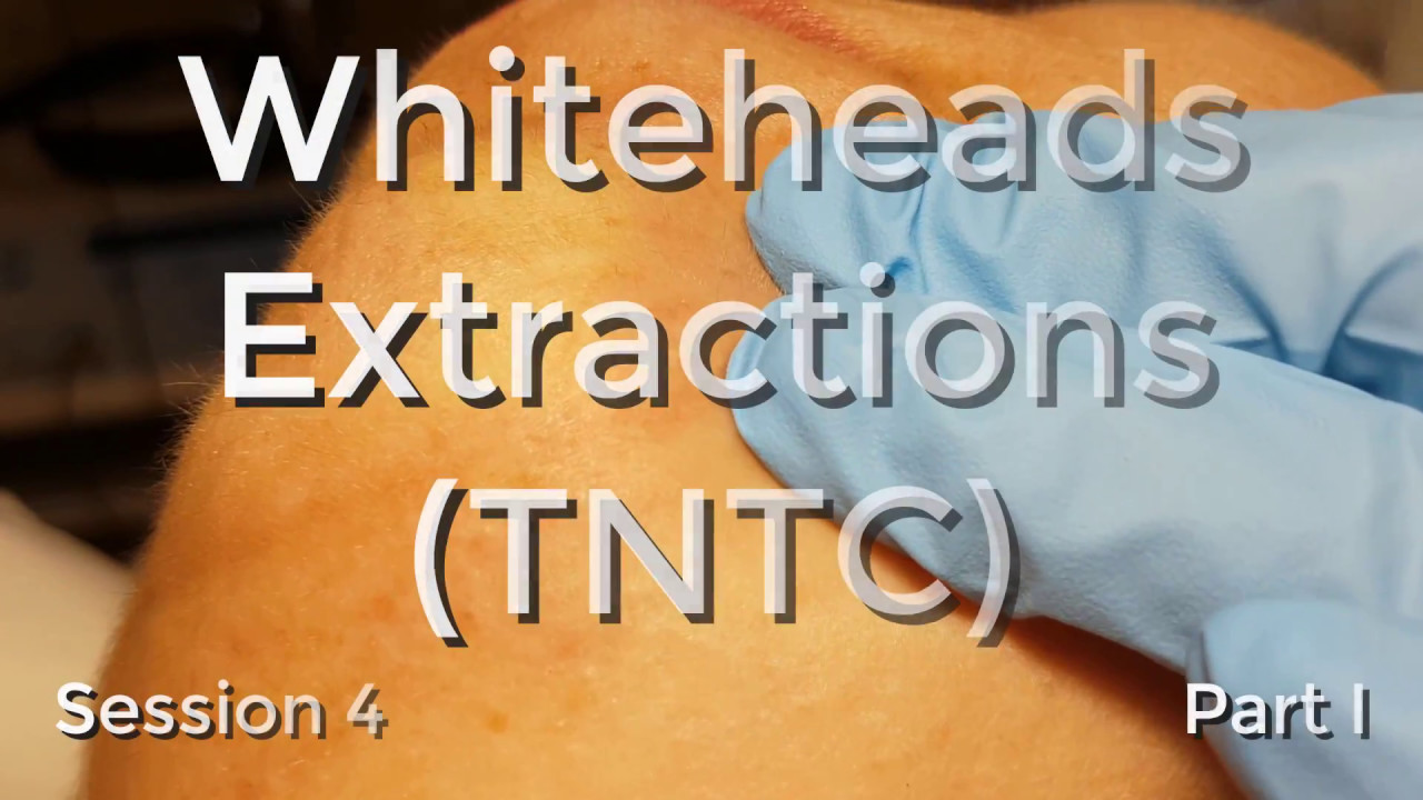 Whiteheads Extraction (TNTC) – Session 4 – Part I