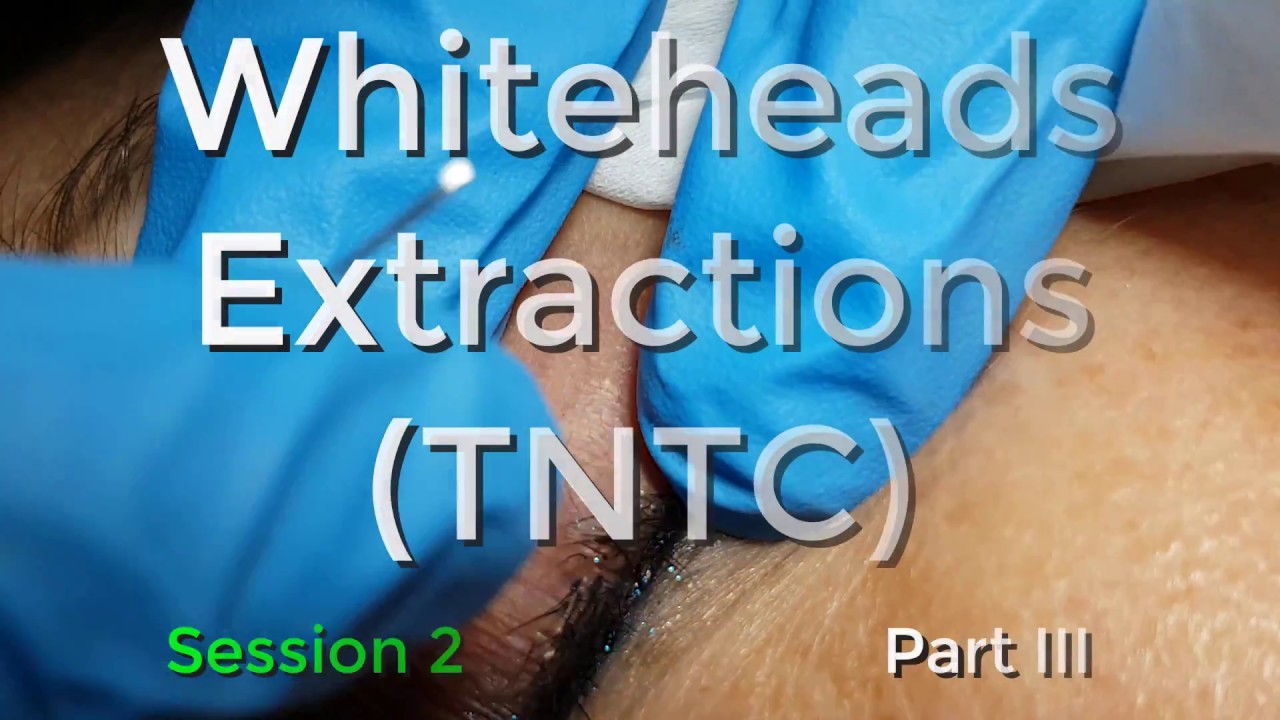 Whiteheads Extraction (TNTC) – Session 2: Part 3 of 3