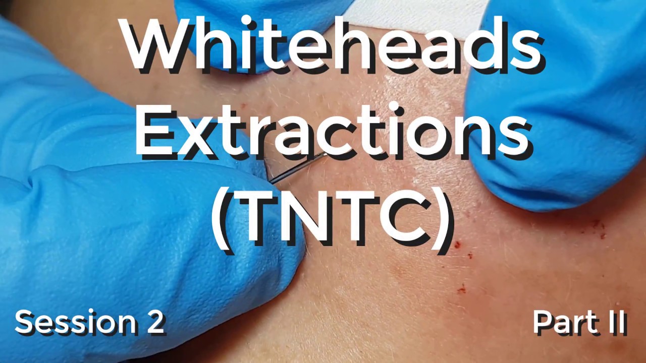 Whiteheads Extraction (TNTC) – Session 2: Part 2 of 3