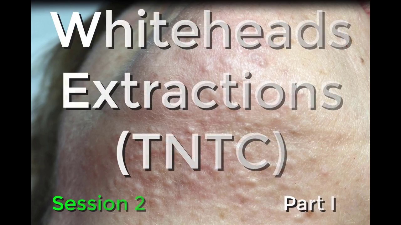 Whiteheads Extraction (TNTC) – Session 2: Part 1 of 3
