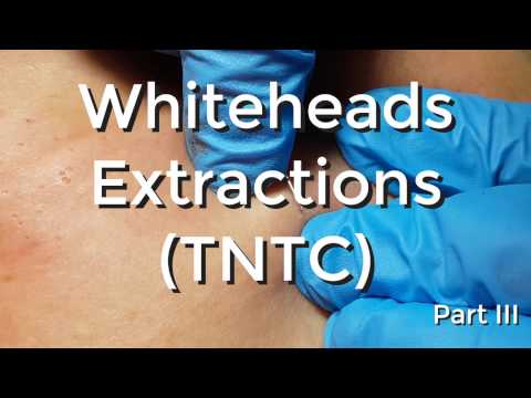 Whiteheads Extraction (TNTC) – Session I – Part 3 of 3