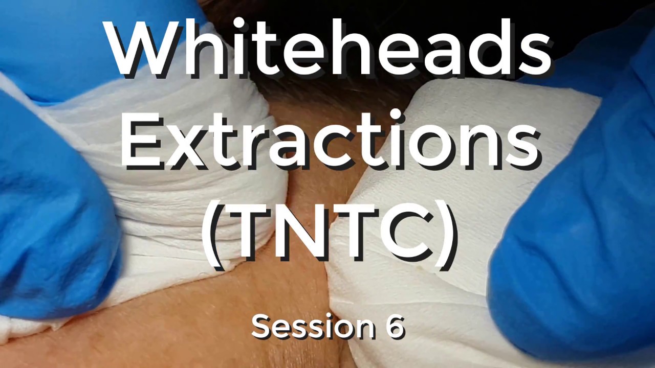 Whiteheads Extraction (TNTC) – Session 6