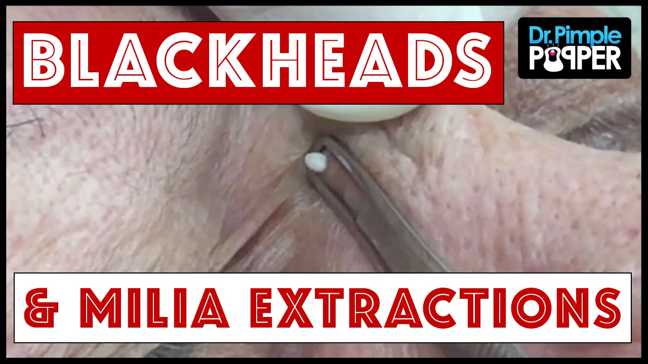 Whiteheads & Milia with Dr Pimple Popper
