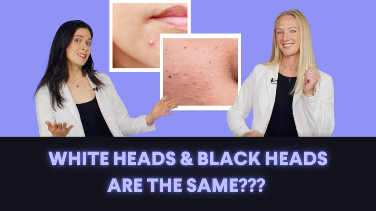 Whiteheads vs Blackheads: What's the Difference? How do you treat these types of acne?