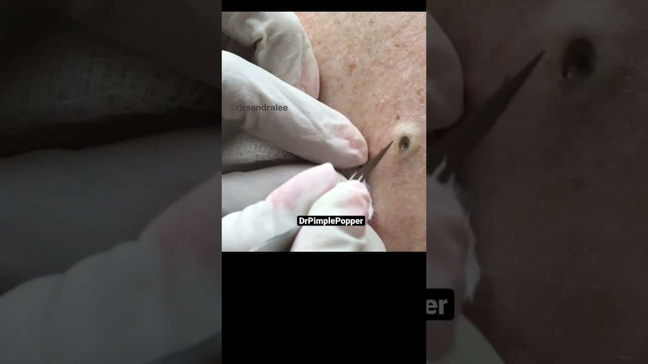 Who loves getting a big squeeze from someone special? #drpimplepopper