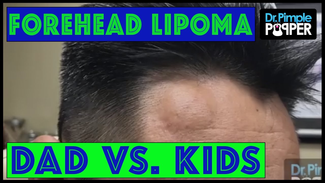 Who’s the BIGGER Popaholic?  A Lipoma on the Forehead