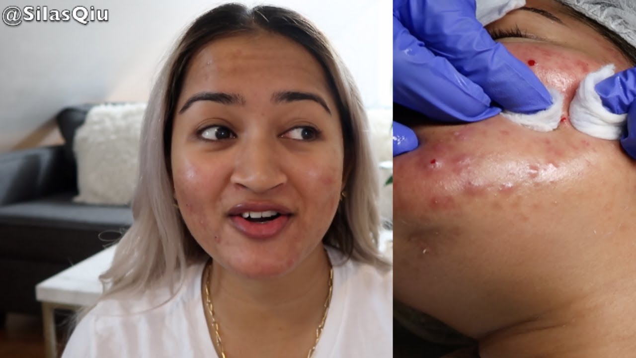 Why Extractions/Pimple Popping Is Important For Your Skin