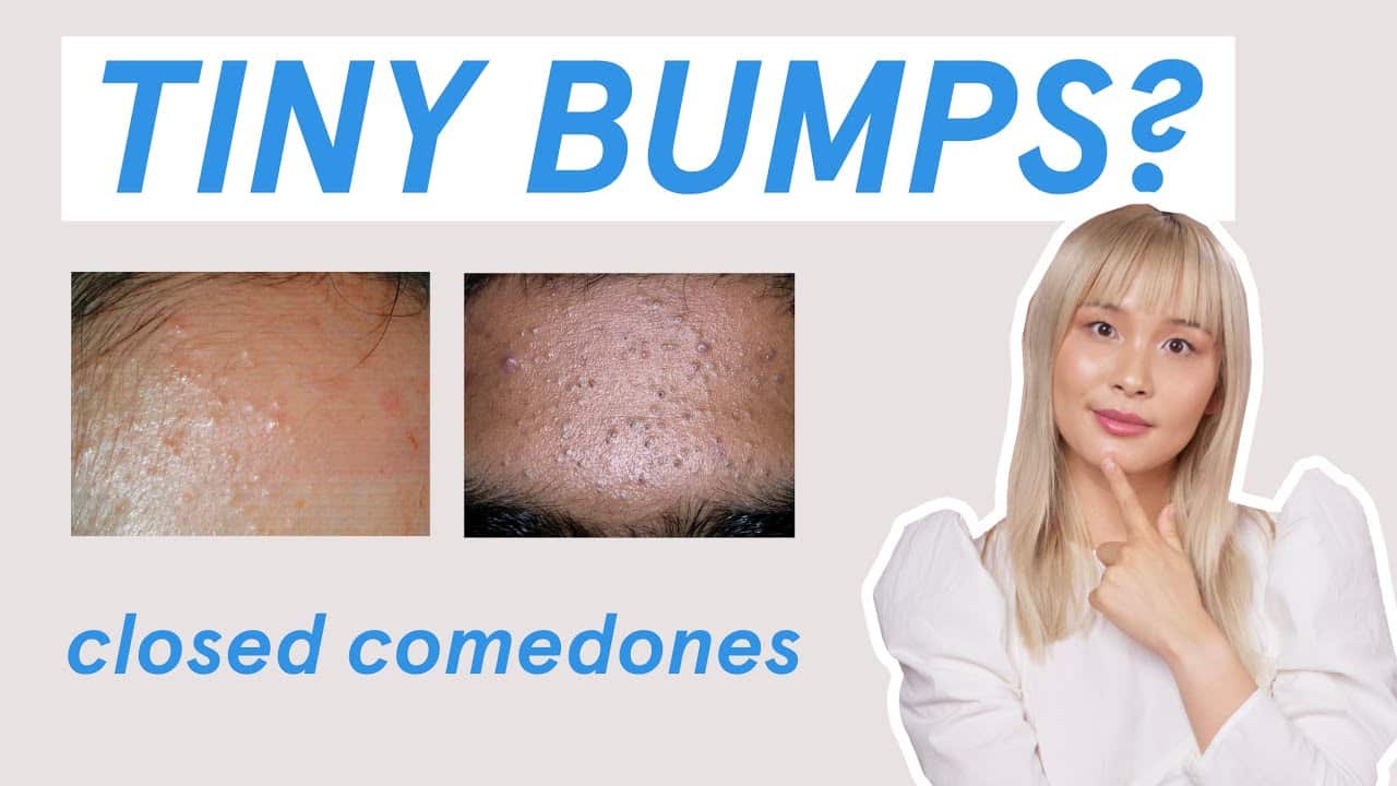 Why those tiny bumps AREN’T fungal acne!