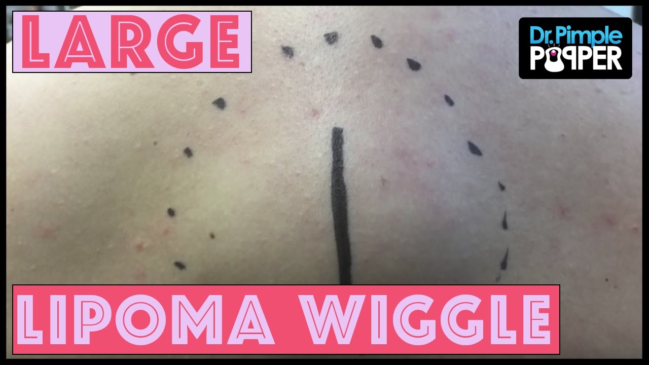Wiggling a Large Lipoma from the Upper Back